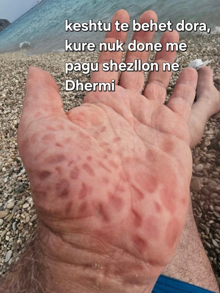 Nese shtriheni ne bark, sapo te qoheni, vishni nje bluze, qe mos te mendojne se keni ndonje semundje infektive. Plazhi i Dhermis dhe Drymades